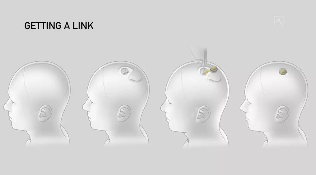 馬斯克發(fā)布腦機(jī)接口重大突破！藍(lán)牙連接，一小時(shí)植入，終極目標(biāo)是實(shí)現(xiàn)數(shù)字永生！